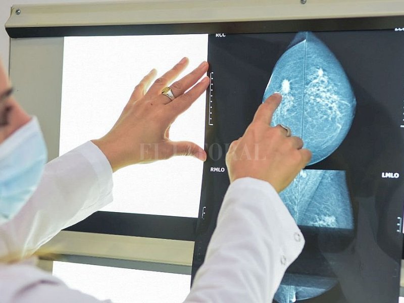 La mamografía es el «gold standard» para la detección de cáncer de mama