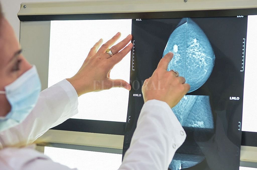 La mamografía es el «gold standard» para la detección de cáncer de mama