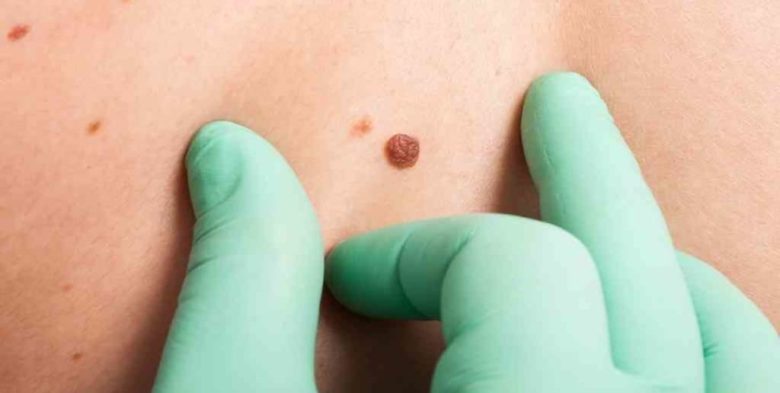 Desarrollo argentino: nueva vacuna contra ciertos tipos de melanoma
