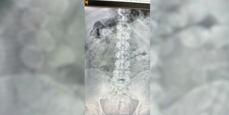 Ceres: dos detenidos que ingirieron 180 cápsulas de cocaína fueron internados